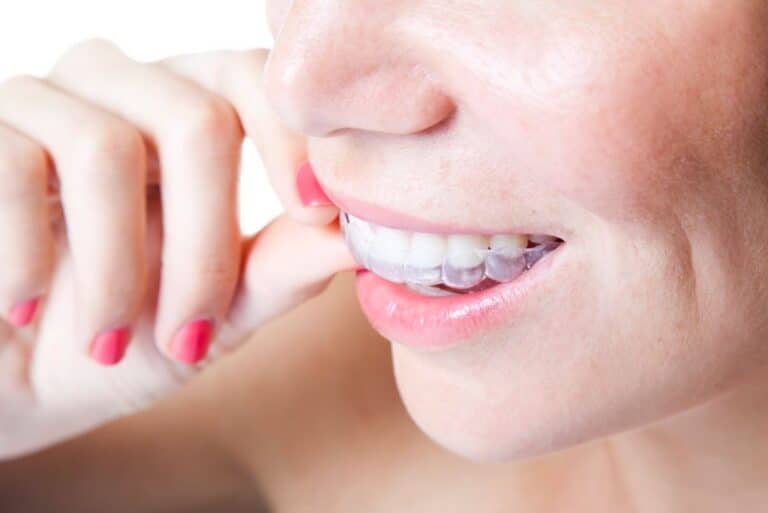 Invisalign in Manhattan Beach