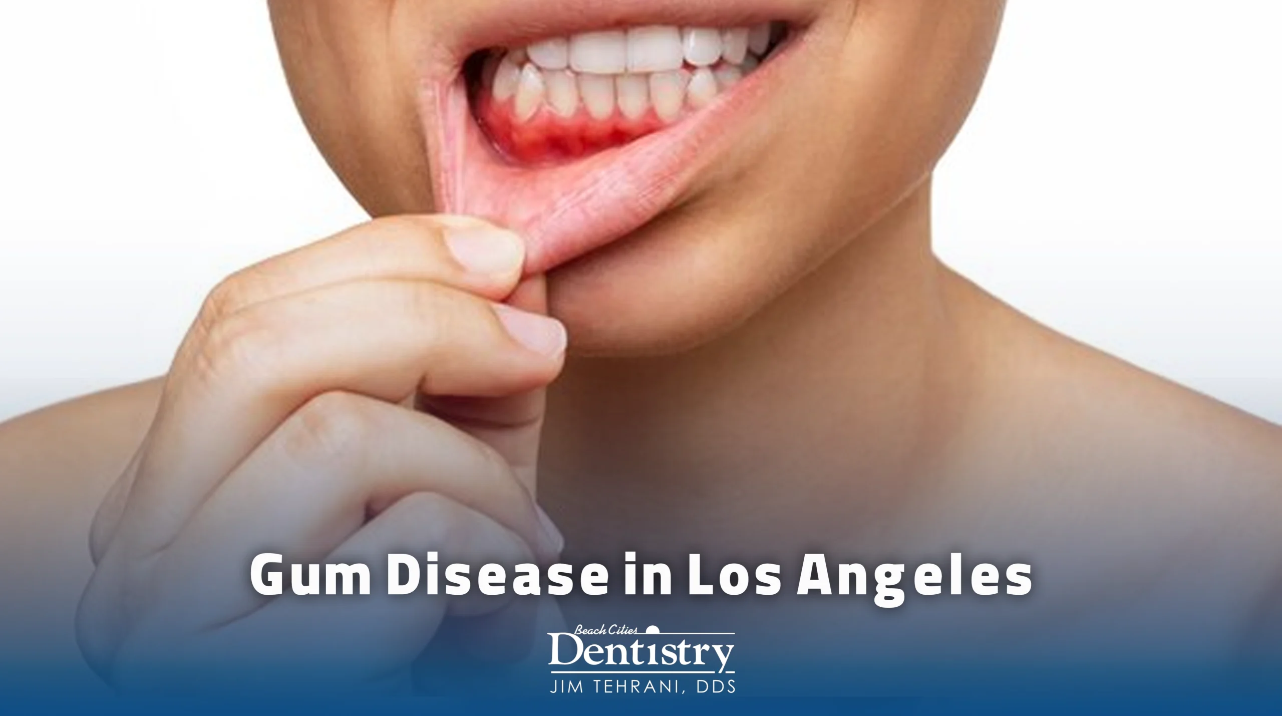 Gum Disease Los Angeles 