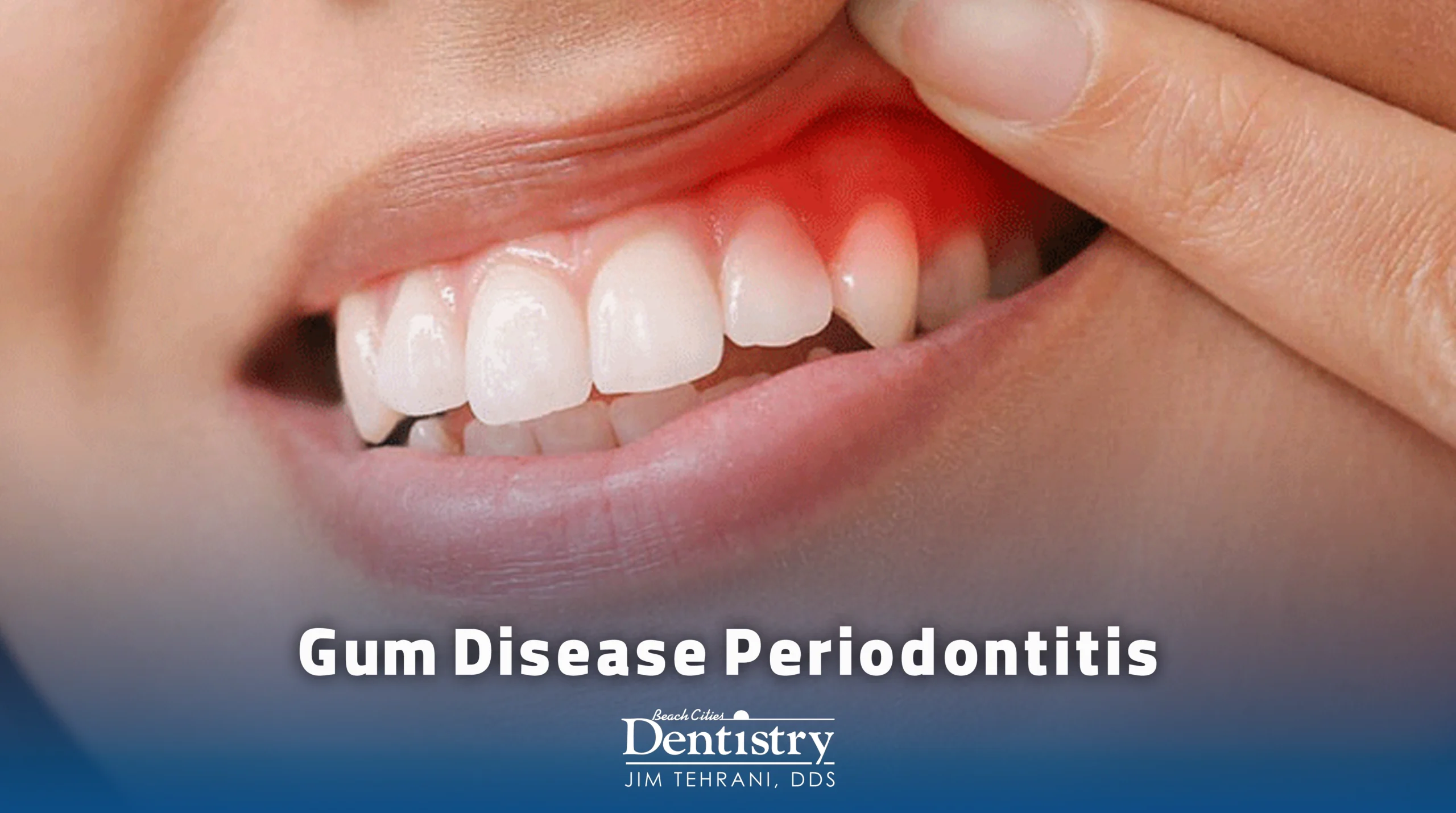 Gum Disease Periodontitis