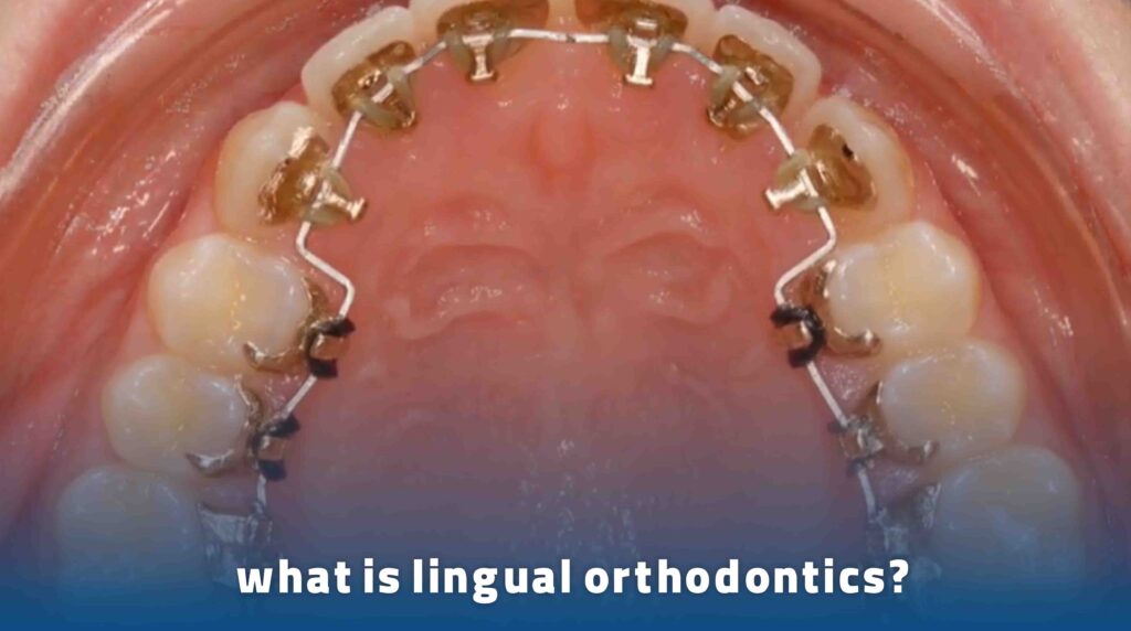 what is lingual orthodontics