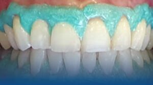 whitening gel