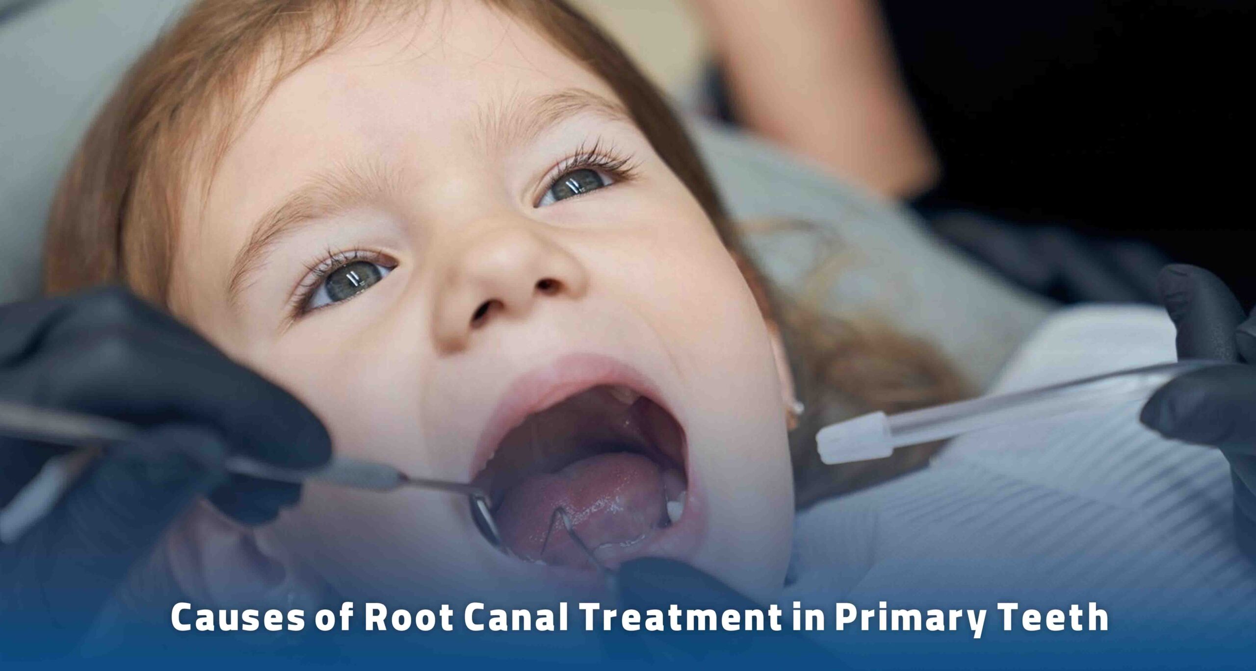 Causes of Root Canal Treatment in Primary Teeth