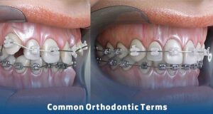 Common Orthodontic Terms