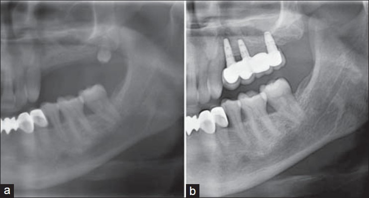 Annals of maxillofacial surgery(2013)